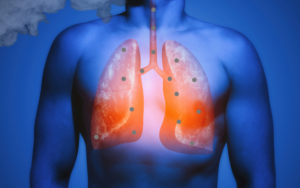 Pyły zawieszone wpływają na płuca
